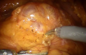 chirurgia del pancreas