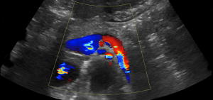 Chirurgia del pancreas